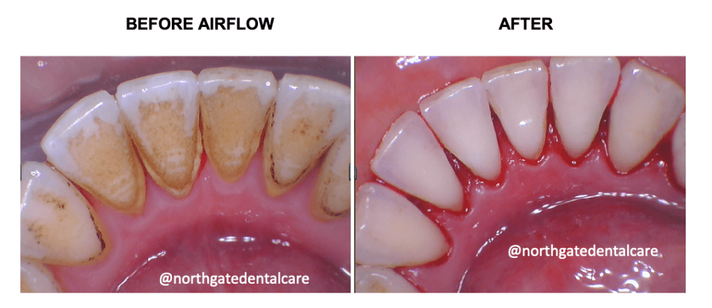 Teeth Whitening ZOOM Dental Treatment